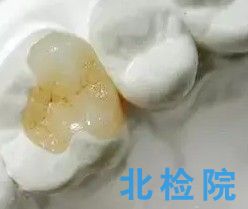 氟化物防齲材料測試