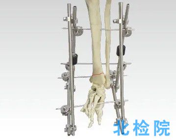 骨科外固定支架測試
